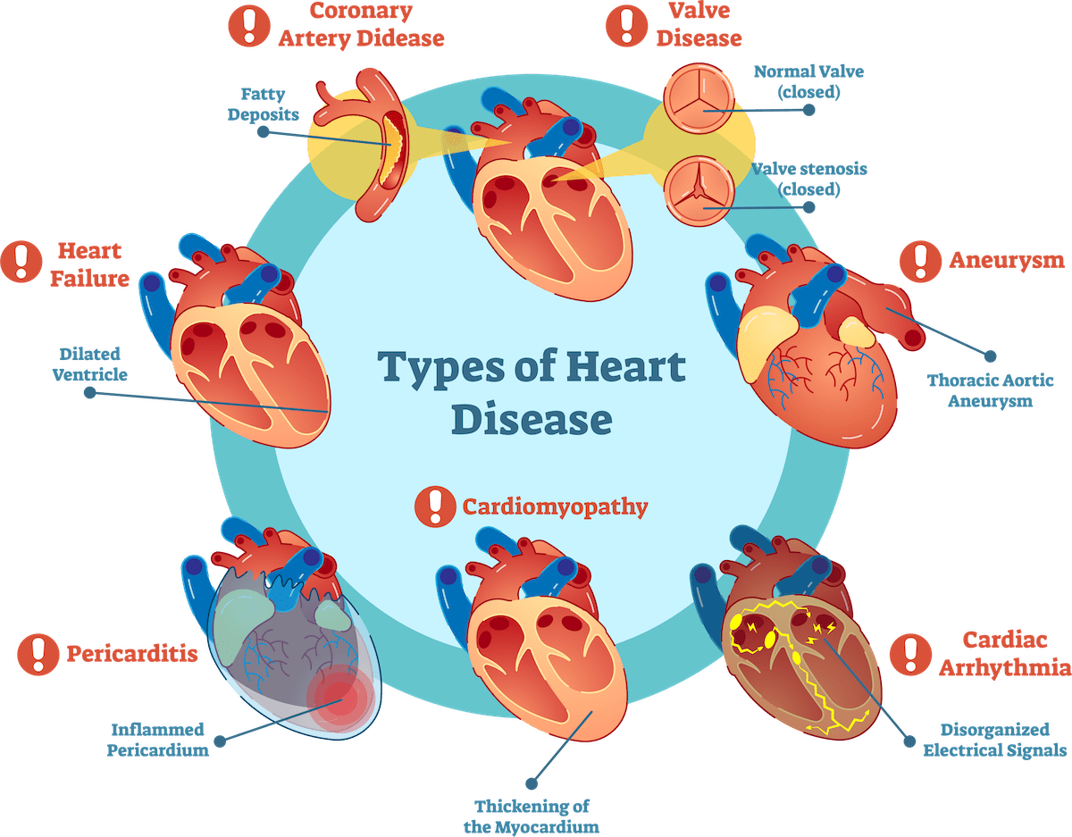 UDMI_Cardiovascular-Disease.png